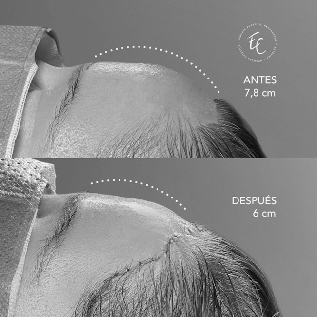 antesydespues-bn-03