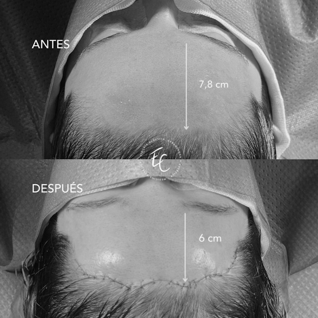 FRONTOPLASTIA PARA REDUCIR TU FRENTE