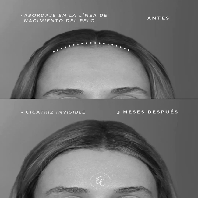 FRONTOPLASTIA PARA REDUCIR TU FRENTE