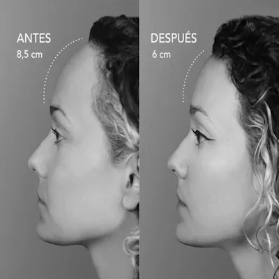 antesydespuesx400-bn-01-1