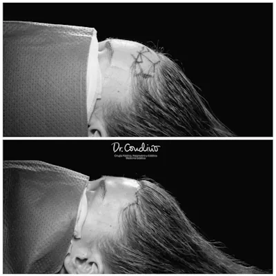 antesydespuesx400-bn-02-1