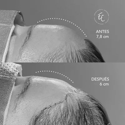 antesydespuesx400-bn-03-1