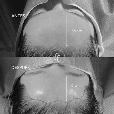 antesydespuesx400-bn-04-1