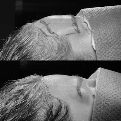 antesydespuesx400-bn-05-1